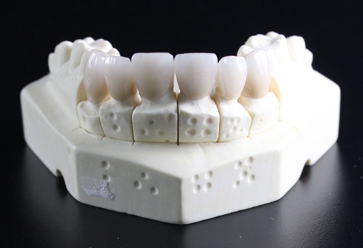 Dental Implant Deals