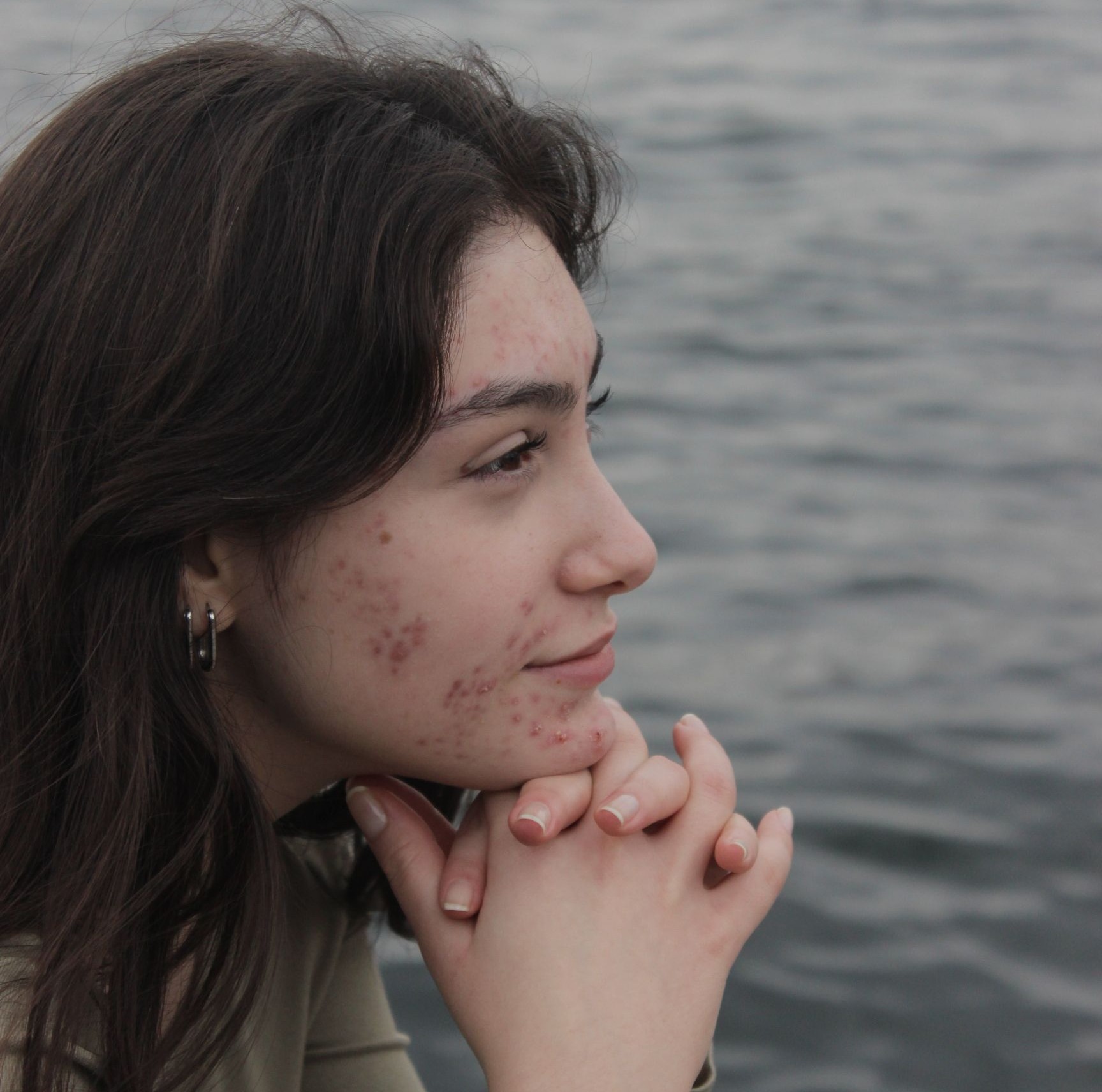 What is Acne? Photo by damla selen demir at Pexels.com
