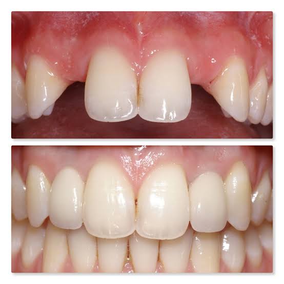 GRACIOUS SMILZ DENTAL CLINIC /ADVANCED MULTISPECIALITY DENTISTRY/ SINCE 2013/DENTAL IMPLANTS/ INVISALIGN ALIGNERS