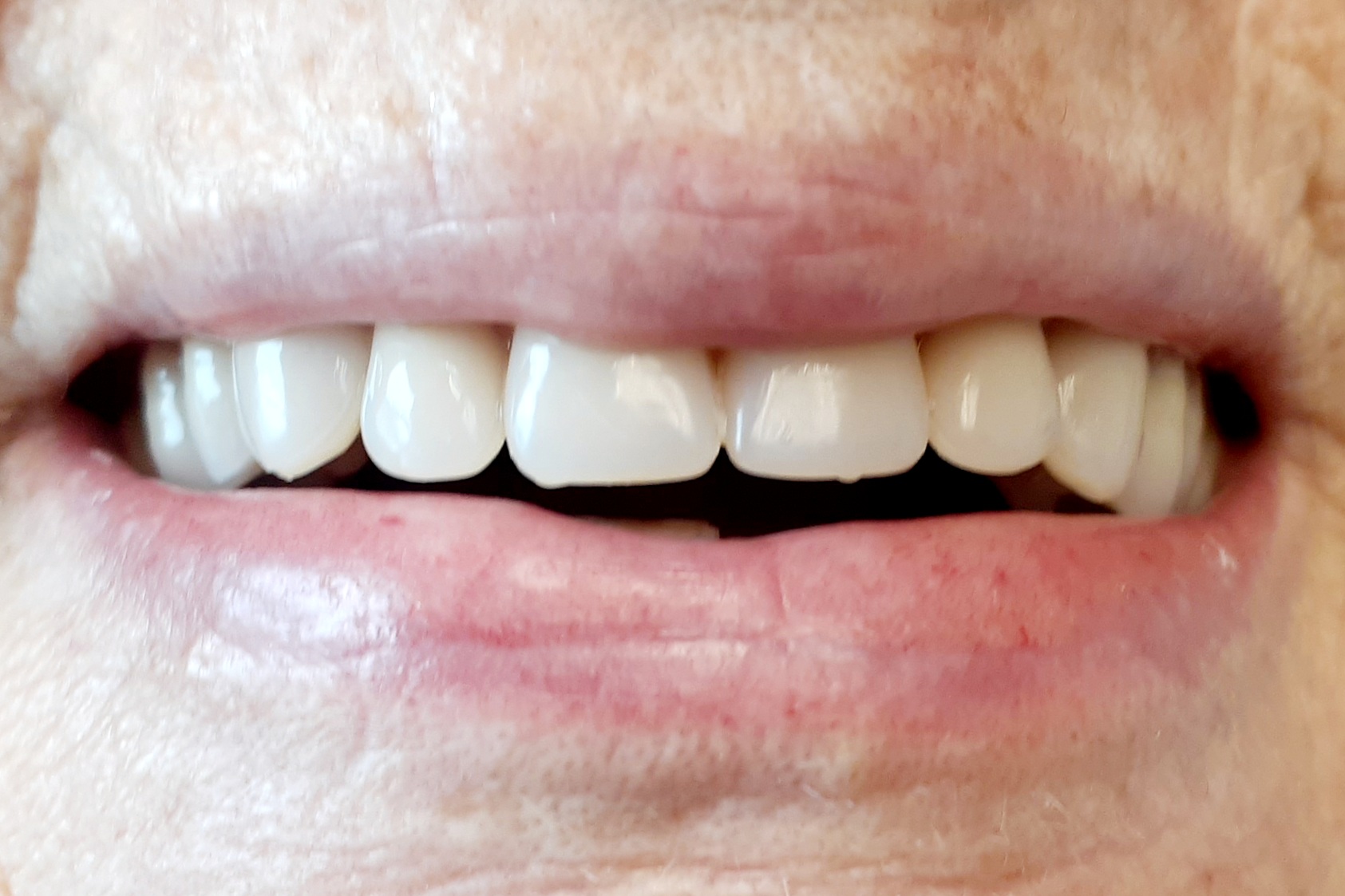 Cohen Cosmetic & Emergency Denture Clinic, EST.1982. CDCP Denture Service Plan Accepted. Expertise In Flexible Dentures.