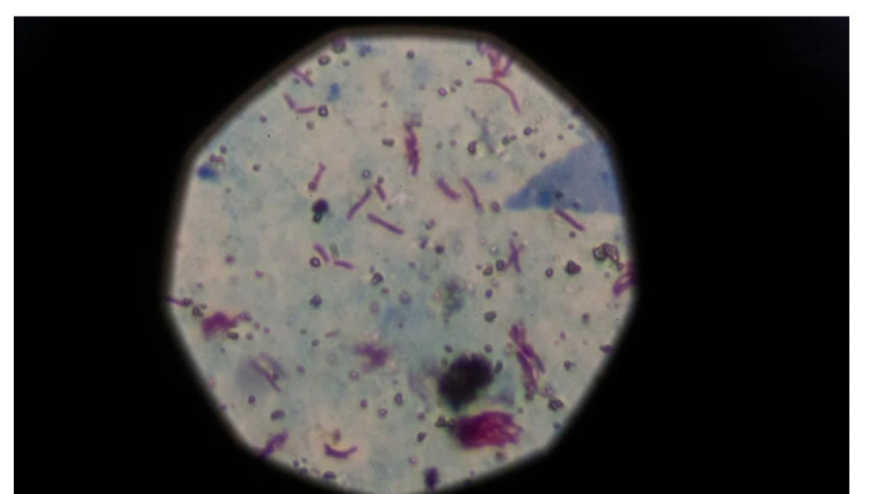 How to Position for Demand During the Malaysian TB Spike